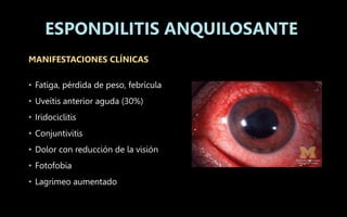 MANIFESTACIONES CLÍNICAS
• Fatiga, pérdida de peso, febrícula
• Uveítis anterior aguda (30%)
• Iridociclitis
• Conjuntivitis
• Dolor con reducción de la visión
• Fotofobia
• Lagrimeo aumentado
ESPONDILITIS ANQUILOSANTE
 