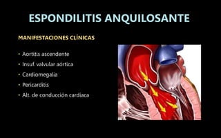 MANIFESTACIONES CLÍNICAS
• Aortitis ascendente
• Insuf. valvular aórtica
• Cardiomegalia
• Pericarditis
• Alt. de conducción cardiaca
ESPONDILITIS ANQUILOSANTE
 