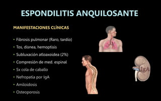 MANIFESTACIONES CLÍNICAS
• Fibrosis pulmonar (Raro, tardío)
• Tos, disnea, hemoptisis
• Subluxación atloaxoidea (2%)
• Compresión de med. espinal
• Sx cola de caballo
• Nefropatía por IgA
• Amiloidosis
• Osteoporosis
ESPONDILITIS ANQUILOSANTE
 