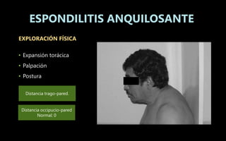 EXPLORACIÓN FÍSICA
• Expansión torácica
• Palpación
• Postura
ESPONDILITIS ANQUILOSANTE
Distancia trago-pared.
Distancia occipucio-pared
Normal: 0
 