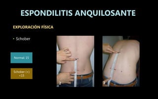 EXPLORACIÓN FÍSICA
• Schober
ESPONDILITIS ANQUILOSANTE
Normal: 15
Schober (+)
<15
 