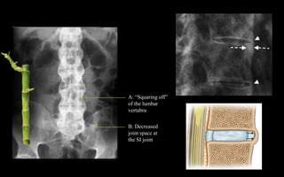 A: “Squaring off”
of the lumbar
vertabra
B: Decreased
joint space at
the SI joint
 