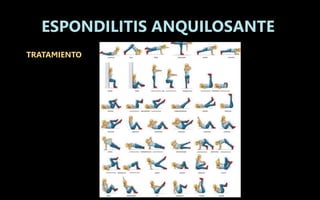 TRATAMIENTO
ESPONDILITIS ANQUILOSANTE
 
