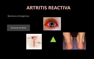 Bacterias artritogénicas
Síndrome de Reiter
ARTRITIS REACTIVA
 