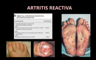 ARTRITIS REACTIVA
 