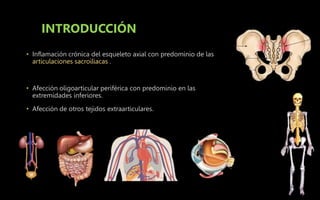 INTRODUCCIÓN
• Inflamación crónica del esqueleto axial con predominio de las
articulaciones sacroiliacas .
• Afección oligoarticular periférica con predominio en las
extremidades inferiores.
• Afección de otros tejidos extraarticulares.
 