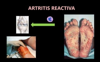 ARTRITIS REACTIVA
 
