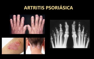 ARTRITIS PSORIÁSICA
 