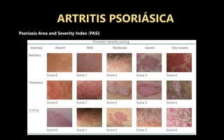 ARTRITIS PSORIÁSICA
Psoriasis Area and Severity Index (PASI)
 