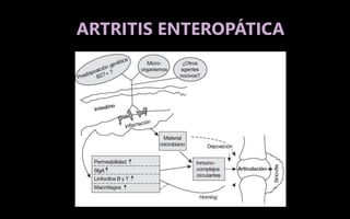 ARTRITIS ENTEROPÁTICA
 
