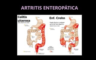 ARTRITIS ENTEROPÁTICA
 