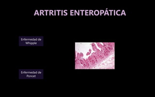 ARTRITIS ENTEROPÁTICA
Enfermedad de
Whipple
Enfermedad de
Poncet
 