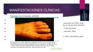 MANIFESTACIONES CLÍNICAS
 OSTEOMUSCULARES
 Dolor lumbar inflamatorio: axial, > 3 meses, < 45 años, hasta 80% de los pacientes con EAR, inicio
insidioso, mejora con el ejercicio, dolor nocturno, buena respuesta a AINEs en las primeras 24-48hs.
 Artritis periférica: inicio agudo, MMII(rodilla, tobillo), edema, asimétrica, < 3 articulaciones.
 Entesitis: tendón de Aquiles, fascia plantar, cresta iliaca, trocánter mayor, epicodilo, tibial,
art.costocondral, tuberosidad humeral, occiput, procesos espinosas.
 Dactilitis/ dedo en salchicha: artritis psoriasica y artritis reactiva (DD: TBC, sífilis, sarcoidosis, gota)
 Otras: dolor caja torácica anterior, intergluteal
 