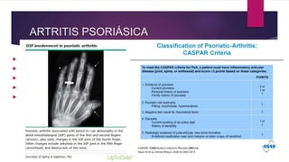 ARTRITIS PSORIÁSICA
 15-20% de los pacientes con psoriasis. Aparece entre 30-50 años.
 Inicio insidioso o agudo y febril (DD cuadros sépticos)
 2 patrones: oligoartritis asimétrica en MMII y poliartritis IFD con onicopatía
 Distribución en eje: afectación de todas las articulaciones de un solo dedo o eje: dedo en salchicha
 Síndrome SAPHO: sinovitis (caja torácica y SI), acné, pustulosis palmoplantar, hiperostosis y osteitis
 