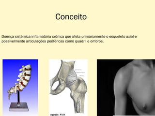 Conceito
Doença sistêmica inflamatória crônica que afeta primariamente o esqueleto axial e
possivelmente articulações periféricas como quadril e ombros.

 