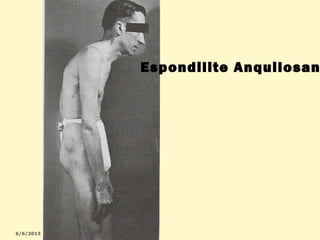 Espondilite Anquilosan

 