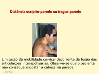 Distância occipito-parede ou tragus-parede

Limitação da mobilidade cervical decorrente da fusão das
articulações interapofisárias. Observe-se que o paciente
não consegue encostar a cabeça na parede

 