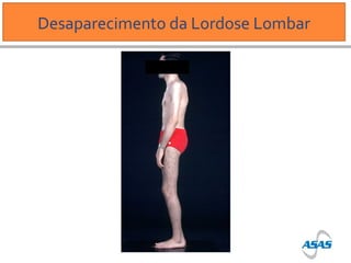 Desaparecimento da Lordose Lombar

 