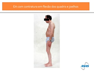EA com contratura em flexão dos quadris e joelhos

 