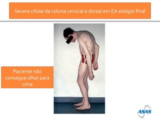 Severa cifose da coluna cervical e dorsal em EA estágio final

Paciente não
consegue olhar para
cima

 