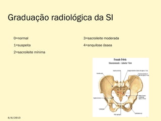 Graduação radiológica da SI
0=normal

3=sacroileite moderada

1=suspeita

4=anquilose óssea

2=sacroileite mínima

 