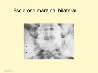 Esclerose marginal bilateral

 