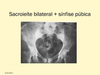 Sacroieíte bilateral + sínfise púbica

 
