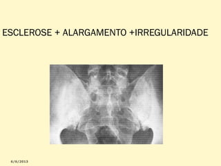 ESCLEROSE + ALARGAMENTO +IRREGULARIDADE

 