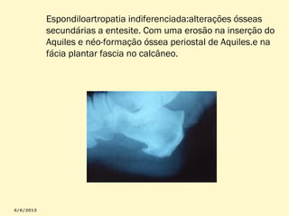 Espondiloartropatia indiferenciada:alterações ósseas
secundárias a entesite. Com uma erosão na inserção do
Aquiles e néo-formação óssea periostal de Aquiles.e na
fácia plantar fascia no calcâneo.

 