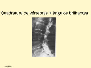 Quadratura de vértebras + ângulos brilhantes

 