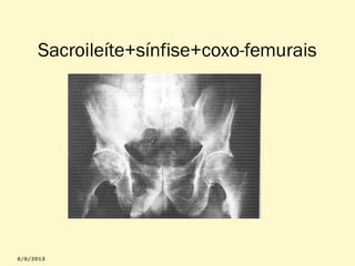Sacroileíte+sínfise+coxo-femurais

 