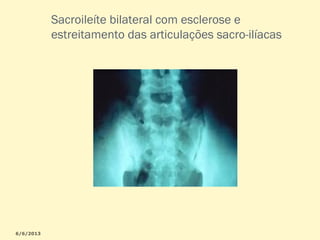 Sacroileíte bilateral com esclerose e
estreitamento das articulações sacro-ilíacas

 