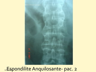 Espondilite Anquilosante- pac. 2

 
