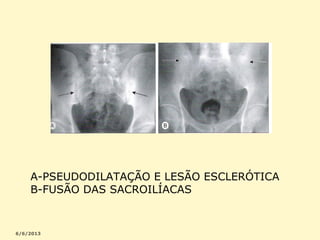 A-PSEUDODILATAÇÃO E LESÃO ESCLERÓTICA
B-FUSÃO DAS SACROILÍACAS

 
