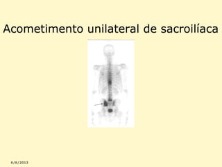 Acometimento unilateral de sacroilíaca

 