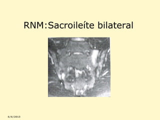 RNM:Sacroileíte bilateral

 