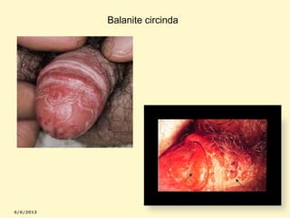 Balanite circinda

 
