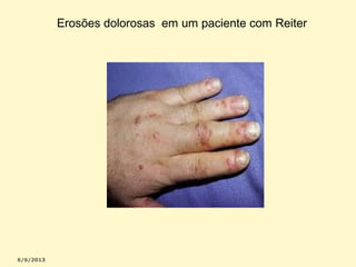 Erosões dolorosas em um paciente com Reiter

 