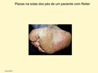 Placas na solas dos pés de um paciente com Reiter

 