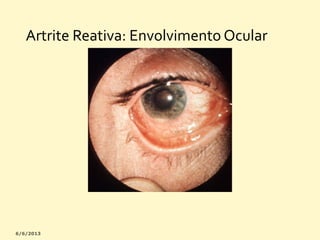 Artrite Reativa: Envolvimento Ocular

 