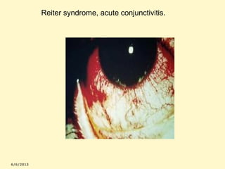 Reiter syndrome, acute conjunctivitis.

 