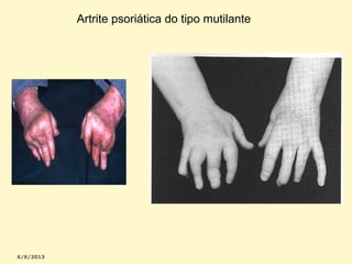 Artrite psoriática do tipo mutilante

 