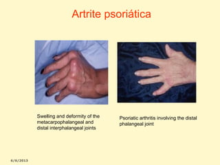 Artrite psoriática

Swelling and deformity of the
metacarpophalangeal and
distal interphalangeal joints

Psoriatic arthritis involving the distal
phalangeal joint

 