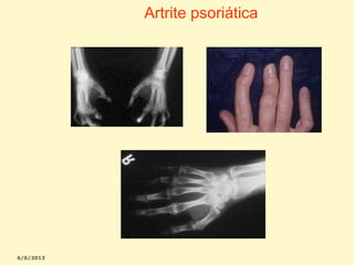 Artrite psoriática

 