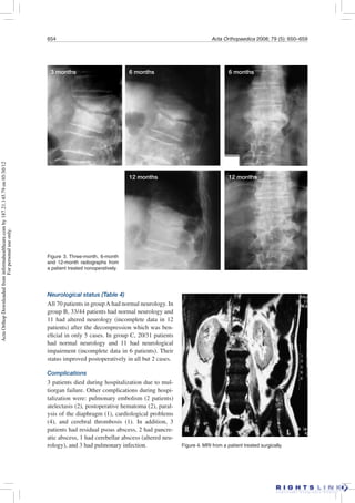 654 Acta Orthopaedica 2008; 79 (5): 650–659
Neurological status (Table 4)
All 70 patients in groupA had normal neurology. In
group B, 33/44 patients had normal neurology and
11 had altered neurology (incomplete data in 12
patients) after the decompression which was ben-
eﬁcial in only 5 cases. In group C, 20/31 patients
had normal neurology and 11 had neurological
impairment (incomplete data in 6 patients). Their
status improved postoperatively in all but 2 cases.
Complications
3 patients died during hospitalization due to mul-
tiorgan failure. Other complications during hospi-
talization were: pulmonary embolism (2 patients)
atelectasis (2), postoperative hematoma (2), paral-
ysis of the diaphragm (1), cardiological problems
(4), and cerebral thrombosis (1). In addition, 3
patients had residual psoas abscess, 2 had pancre-
atic abscess, 1 had cerebellar abscess (altered neu-
rology), and 3 had pulmonary infection. Figure 4. MRI from a patient treated surgically.
Figure 3. Three-month, 6-month
and 12-month radiographs from
a patient treated nonoperatively.
3 months 6 months 6 months
12 months 12 months
ActaOrthopDownloadedfrominformahealthcare.comby187.21.145.79on05/30/12
Forpersonaluseonly.
 
