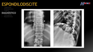 ESPONDILODISCITE
• CONCEITOS
• EPIDEMIOLOGIA
• CLÍNICA
DIAGNÓSTICO
• TRATAMENTO
• PROGNÓSTICO
 