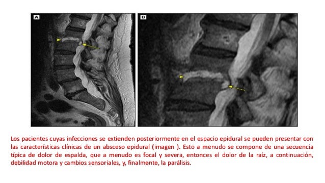 espondilodiscitis infecciosa