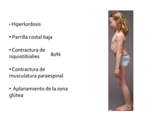 • Hiperlordosis
• Parrilla costal baja
• Contractura de
isquiotibialies
• Contractura de
musculatura paraespinal
• Aplanamiento de la zona
glútea
80%
 