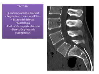 TACY RM
• Lesión unilateral o bilateral
• Seguimiento de espondilólisis
• Estado del defecto
• Morfología
• Evaluación de partes blandas
• Detección precoz de
espondilólisis
 