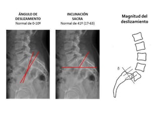 Magnitud del
deslizamiento
 